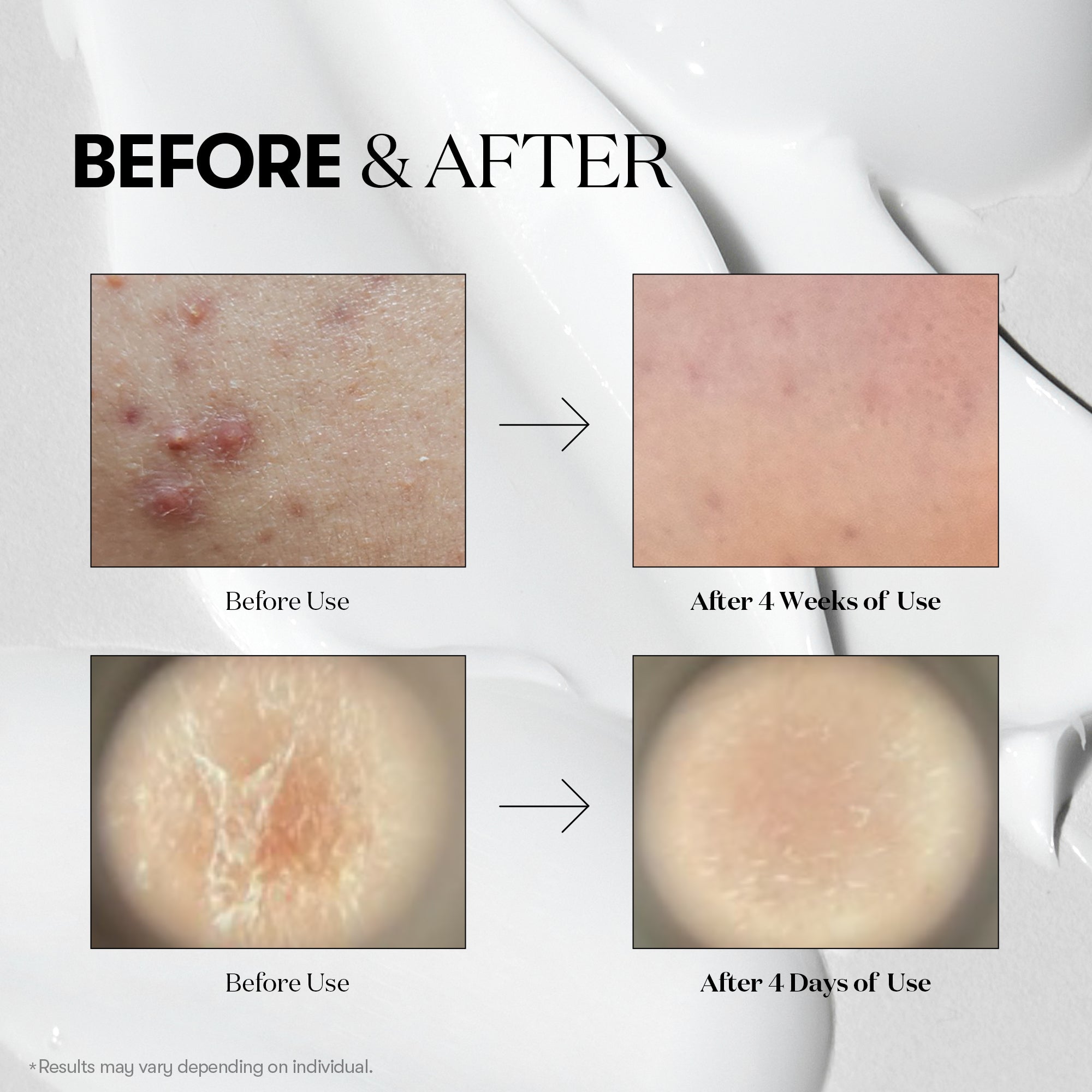 Brand before/after photographs after four weeks and four days; individual results vary.